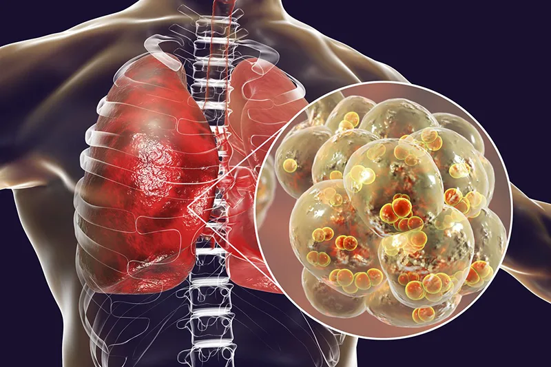 Ho kéo dài không khỏi đôi khi có thể liên quan đến lao phổi, giãn phế quản, COPD hoặc ung thư phổi, đặc biệt khi xuất hiện dấu hiệu cảnh báo.