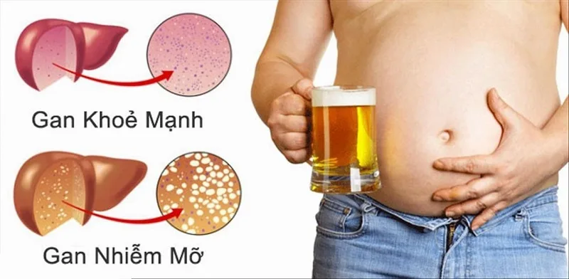 Nguyên nhân nào khiến gan bị nhiễm mỡ?