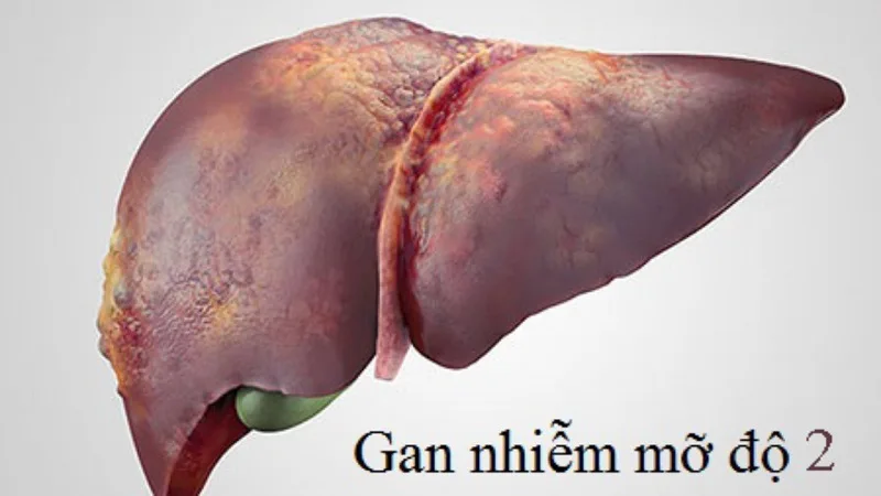 Gan nhiễm mỡ có mấy mức độ?